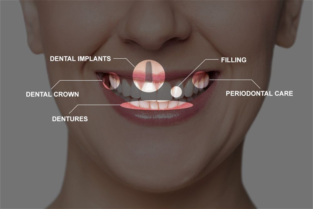 parts of full mouth reconstruction